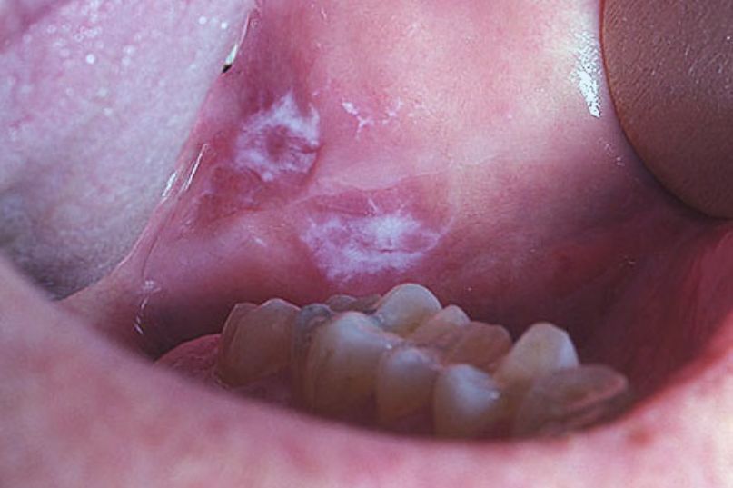 cause of mouth cancer