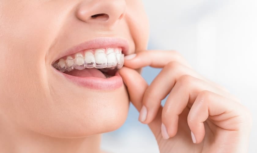 smile avenue family dentistry of katy common invisalign myths