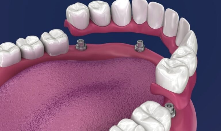 Smile Avenue Family Dentistry Of Katy Dental Implant Aftercare Guide For Optimal Healing