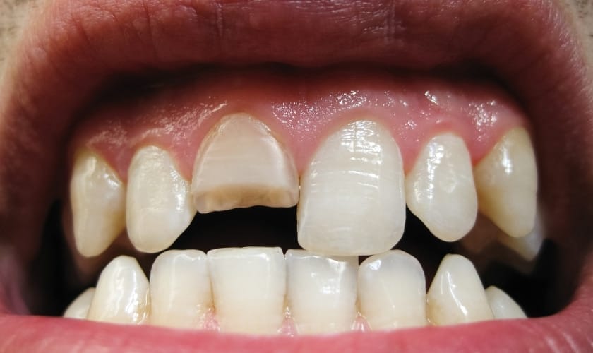 dentist katy patrick vuong explains common signs of a cracked tooth