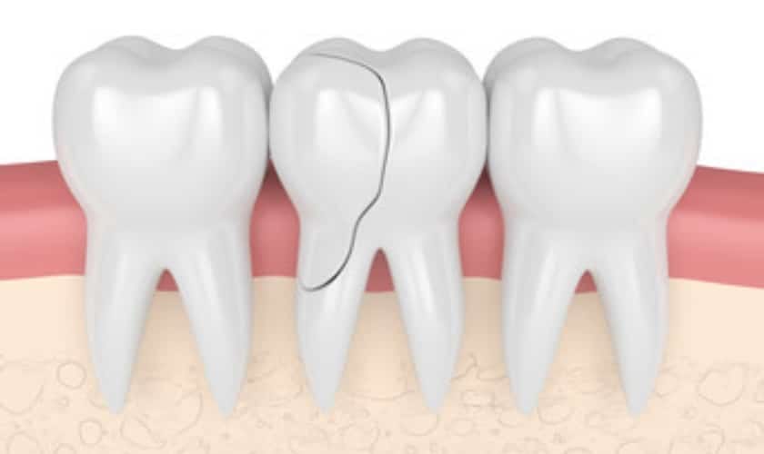 cracked tooth fractured tooth syndrome