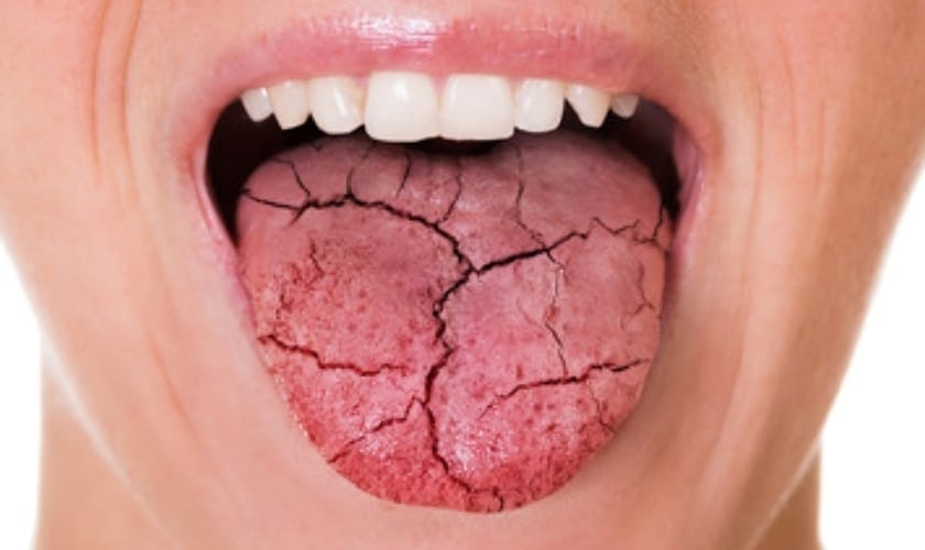 dry mouth symptoms and causes