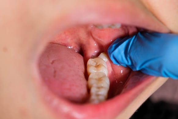 how long wisdom tooth growing pain lasts for optimal relief