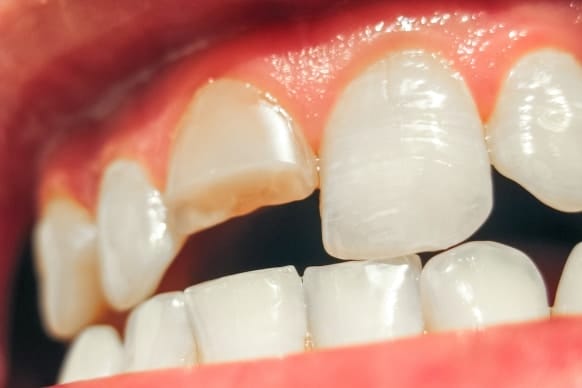 how to fix a cracked tooth