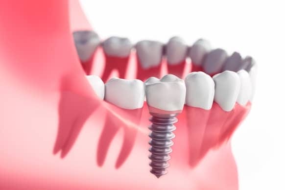 what does a tooth implant look like