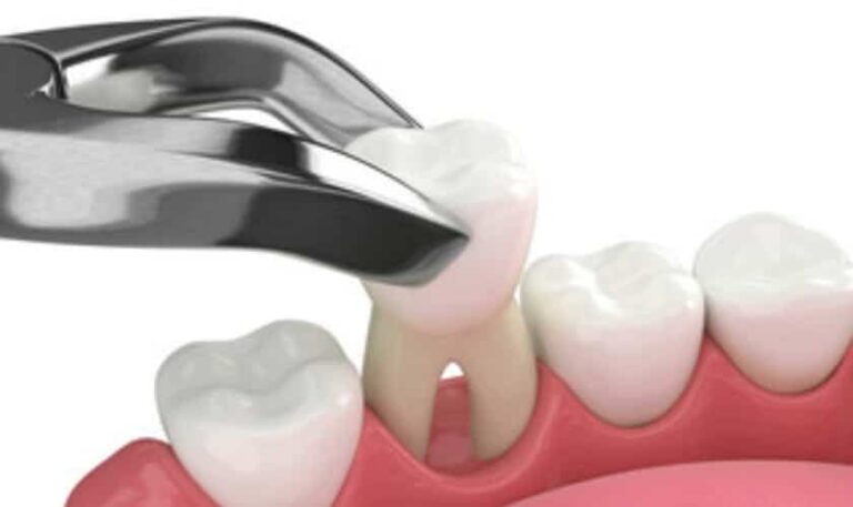 When To Discontinue Gauze Application After Tooth Extraction