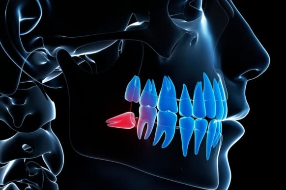 3D illustration of a human jaw highlighting wisdom teeth, with one impacted tooth in red, symbolizing pain and discomfort. Understanding Wisdom Tooth Pain Duration and Relief Methods.