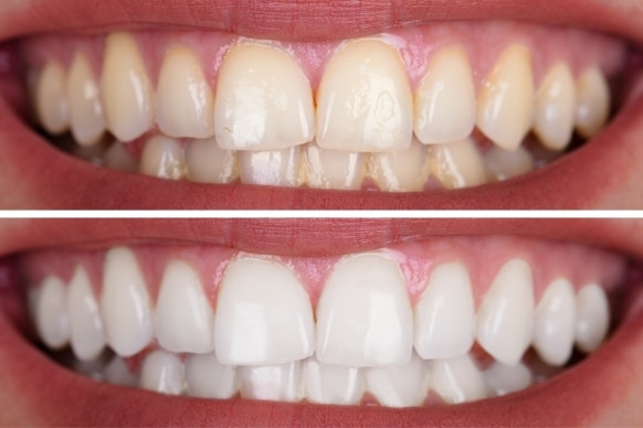 hydrogen peroxide safe for teeth whitening