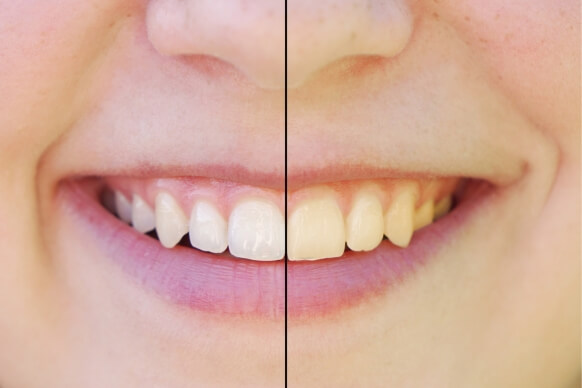 teeth look more yellow after whitening strips