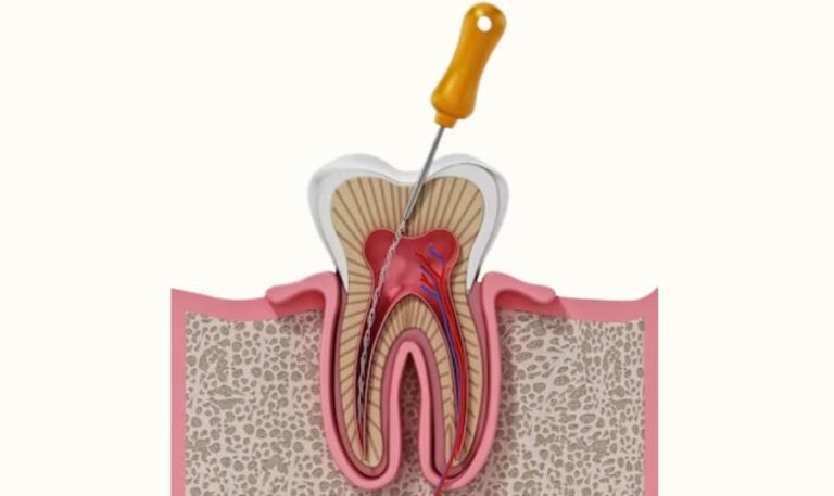 Clear Up Tooth Infection Without A Root Canal