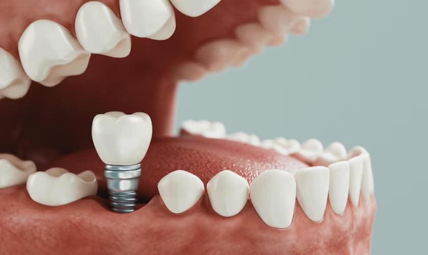 dental implants improve your bite and chewing ability