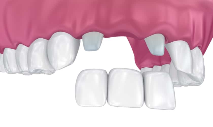 cause of fixed dental bridge failure