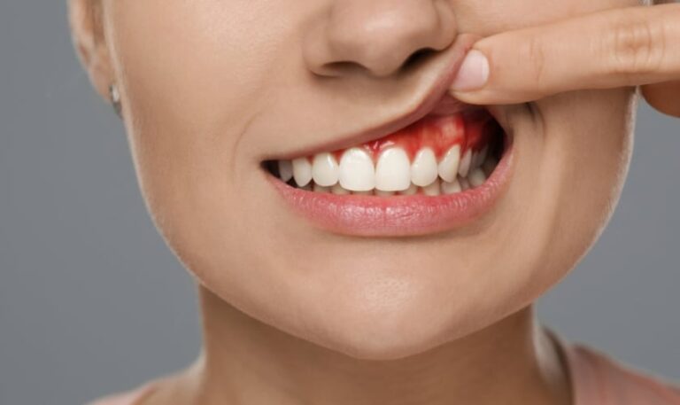 Gum Disease Severity
