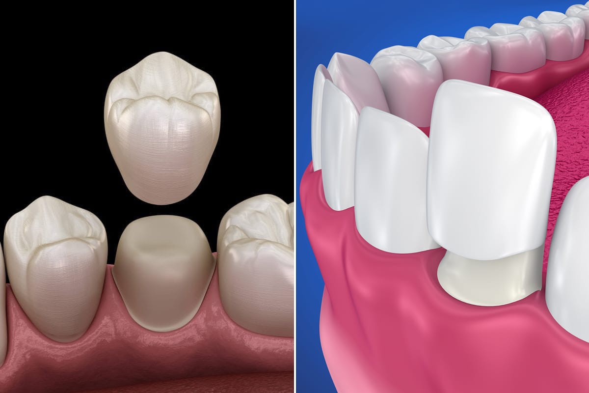 Crowns vs. Veneers Understanding the Best Dental Option for You