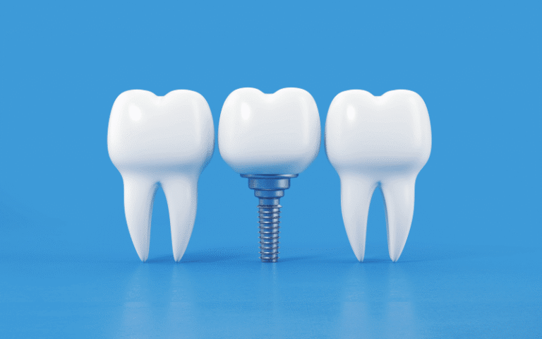 Benefits Of Dental Implants