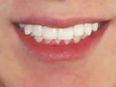 Close-up of a smiling person's teeth showcasing results from family dental care and cosmetic dentistry in Katy, TX at Smile Avenue.
