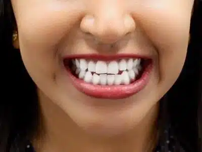 A close-up image of a person smiling with perfectly aligned, white teeth. The image highlights the results of cosmetic dentistry at Smile Avenue in Katy, TX, showcasing dental care and aesthetic improvements.