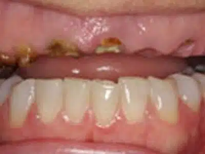 Before and after dental transformation showing improved dental health with new, bright white teeth replacing damaged and decayed teeth. Demonstrates effective cosmetic dentistry results from Smile Avenue in Katy, TX.