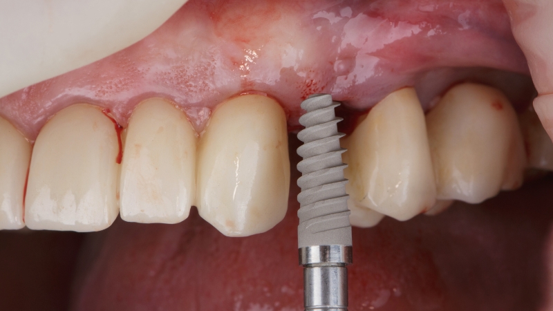 how can implant dental improve smile