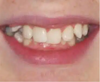 Close-up of a person's smile showing teeth with visible dental work, emphasizing cosmetic dentistry at Smile Avenue in Cypress, TX.