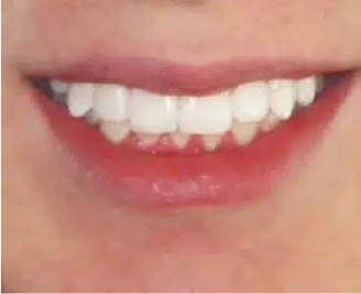 Close-up of a person's healthy white smile showcasing dental care and cosmetic dentistry results at Smile Avenue in Cypress, TX.