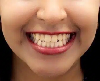 Close-up of a person smiling, showcasing healthy teeth with red lipstick, representing quality dental and cosmetic care at Smile Avenue, Cypress TX.