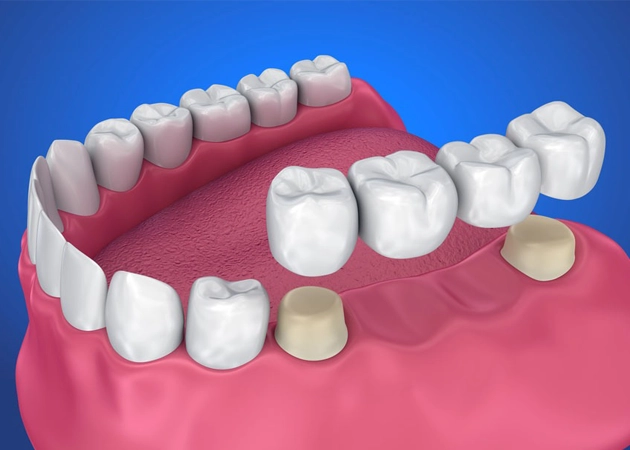 3D illustration of dental crowns and bridges application process on teeth for restorative dentistry in Cypress, TX. Close-up of dental implants in gum structure demonstrating the use of dental crowns and bridges.