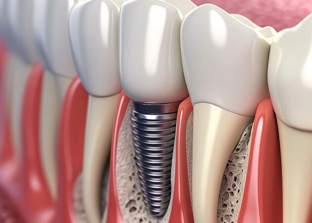 Close-up illustration of dental implants showing a metal implant post fused with the jawbone, surrounded by natural teeth, highlighting advanced dental care at Smile Avenue Dentistry in Cypress, TX.