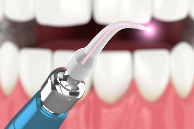 Illustration of a dental laser tool targeting gums, demonstrating painless laser gum disease surgery, emphasizing treatment in Cypress.