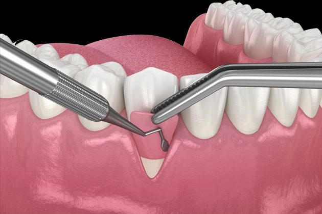 Illustration of advanced gum therapy procedure demonstrating dental instruments used in periodontal treatment to restore healthy gums in Cypress.