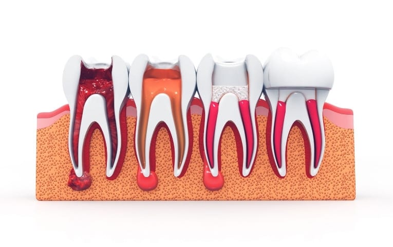 what happens if you delay a root canal