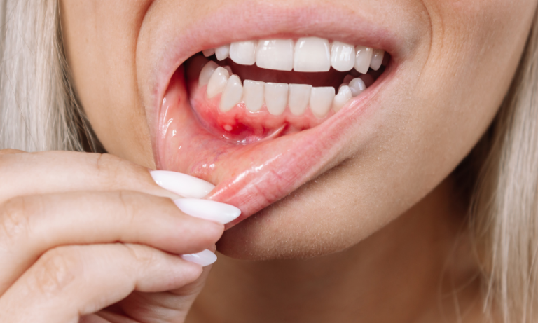 How Delayed Gum Disease Treatment Affects Your Oral And Overall Health