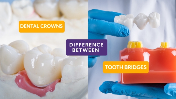 difference between dental crowns and tooth bridges