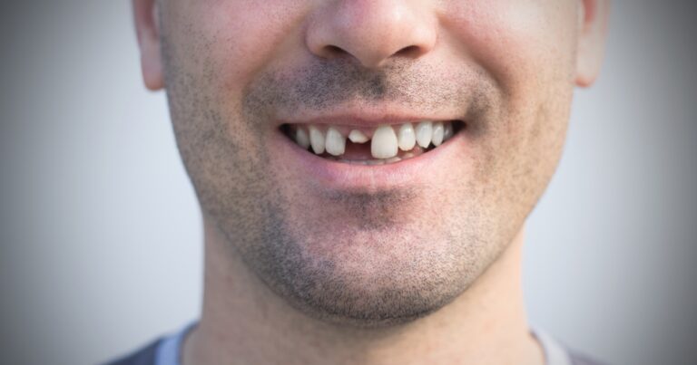 My Tooth Is Knocked Out