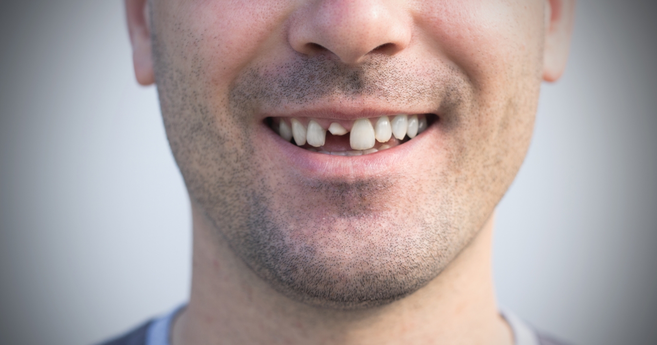 my tooth is knocked out