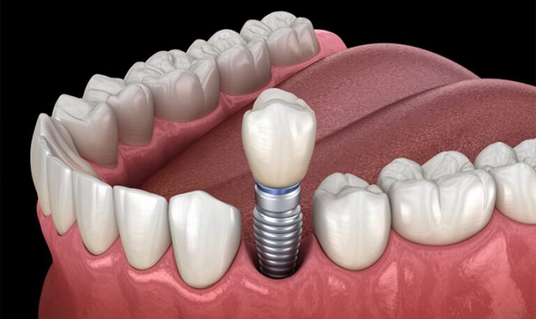 Dental Implants In Cypress