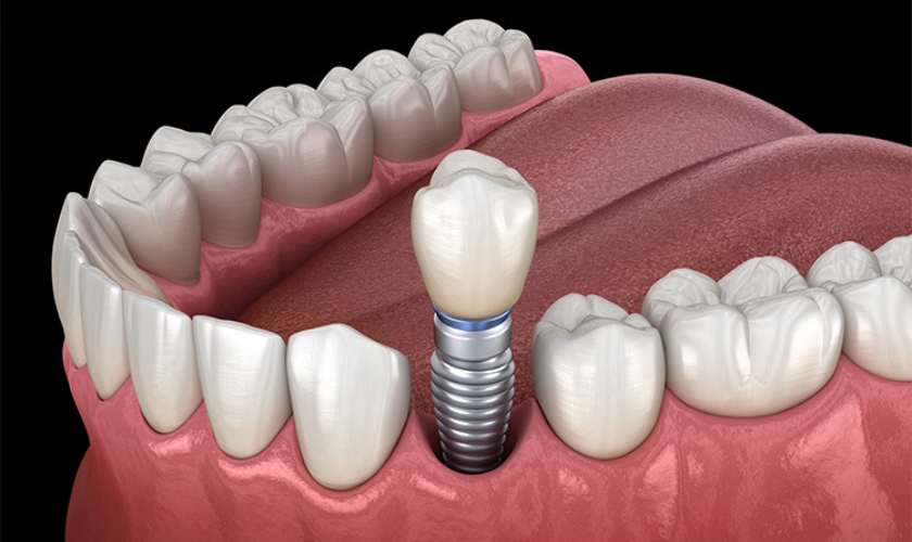 dental implants in Cypress