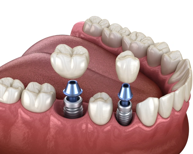 in-house-dental-lab