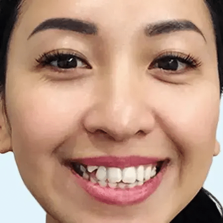 Invisalign Aligners1 17 Young Asian Woman Smiling