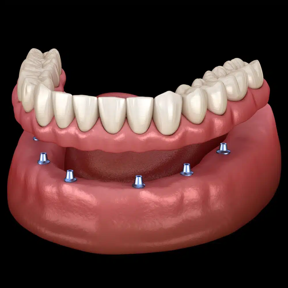 Dental Implant Cypress TX 14 Dental Implant Model Showing Multiple Implants In A Lower Jaw On Black Background