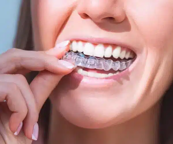 Invisalign Aligners1 21 Close Up Of A Woman'S Smile Showing Invisalign Aligners On Her Teeth