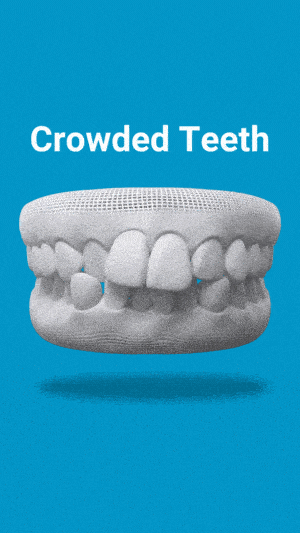 Invisalign Aligners1 9 Illustrated Dental Model Showing Crowded Teeth With Blue Aligner On A Blue Background