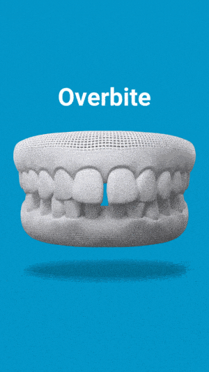 Invisalign Aligners1 10 Illustrated Dental Model Showing An Overbite With Blue Aligner On A Blue Background