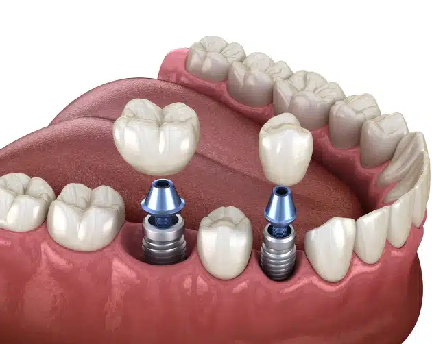 Dental Implant Cypress TX 2 Dental Model Showing Two Implants And Crowns Placed In A Lower Jaw