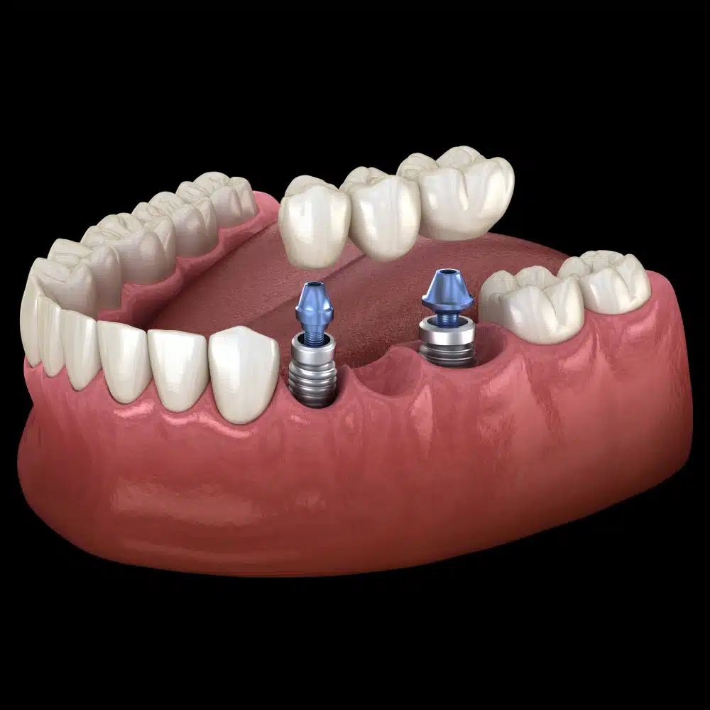 Dental Implant Cypress TX 13 Dental Implant Model Showing Two Implants Placed In A Lower Jaw On Black Background
