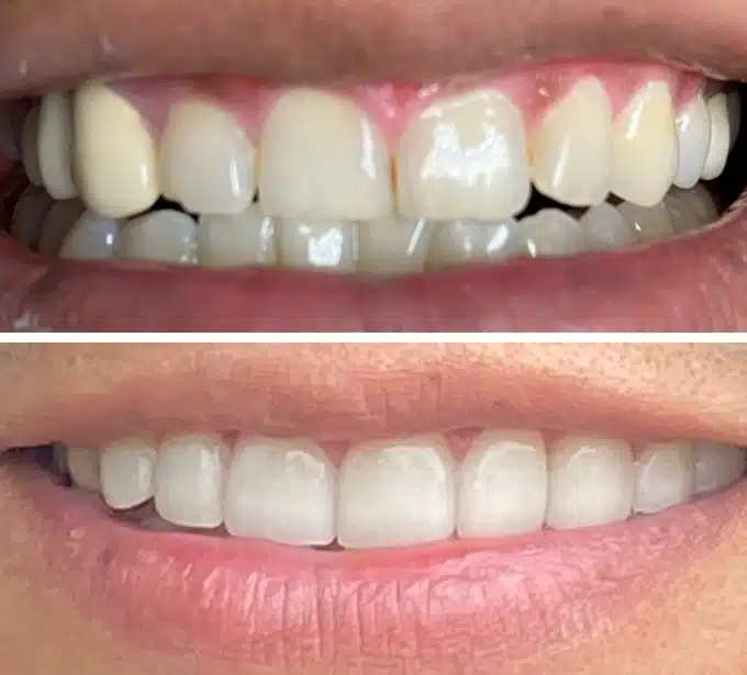 Dental Implant Cypress TX 16 Before And After Implant Treatment At Smile Avenue Family Dentistry