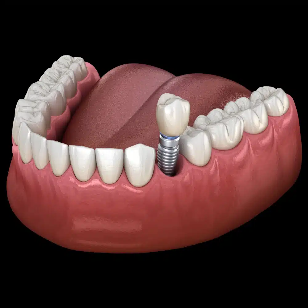 Dental Implant Cypress TX 12 Dental Model Showing An Implant And Surrounding Teeth On Black Background